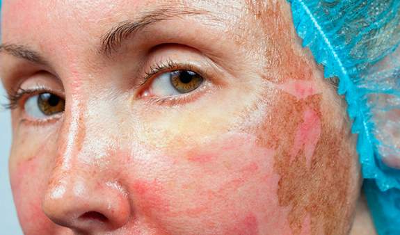 O Que é e Como Funciona um Peeling Químico?
